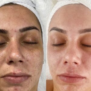 پک اسید تراپی آنوبیس