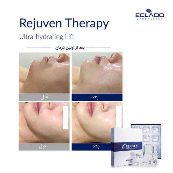 تراپی رجوون Rejuven اکلادو