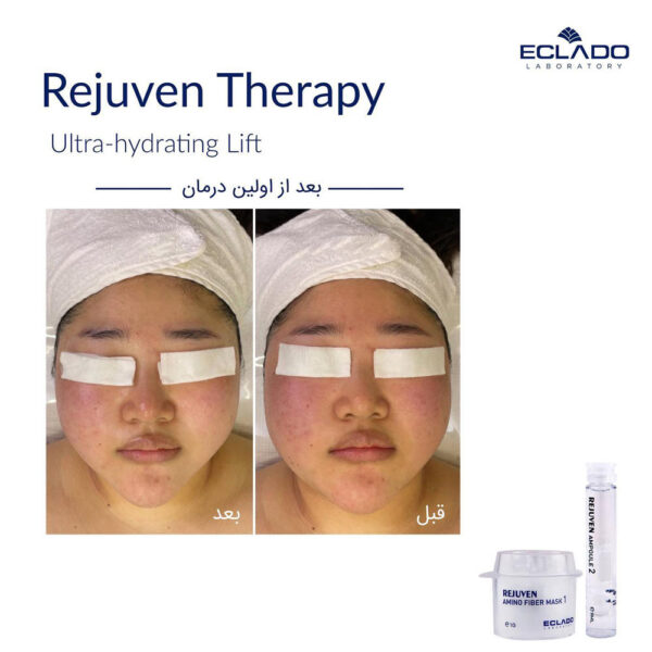 تراپی رجوون Rejuven اکلادو