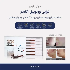 تراپی اسید ونوپیل اکلادو