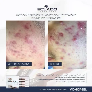 تراپی اسید ونوپیل اکلادو