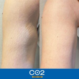 ژل کربوکسی ریب اسکین