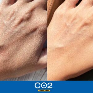 ژل کربوکسی ریب اسکین